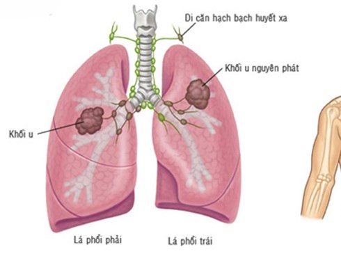 Loại quả rẻ nhất Việt Nam khiến tế bào ung thư không thể di căn