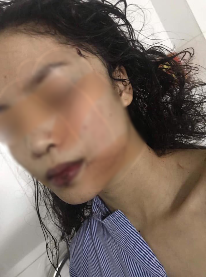 Bắc Ninh: Cô gái 18 tuổi bị bạn cũ lao vào phòng rạch mặt, cổ và tay, phải khâu 60 mũi-1