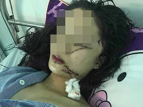 Chị gái thiếu nữ xinh đẹp bị rạch mặt: Em tôi kêu có thai mà họ vẫn không tha”-3
