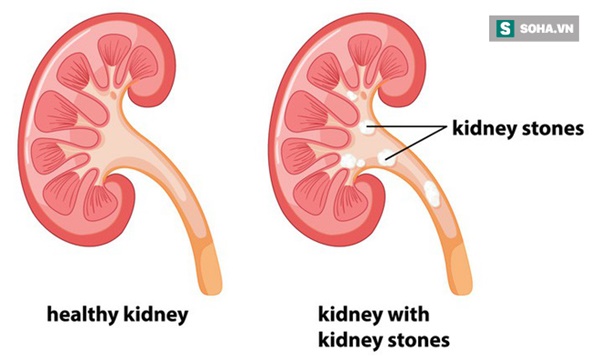 Muốn loại bỏ sỏi thận triệt để: Quan trọng nhất là giữ mồm giữ miệng trước những món này-1