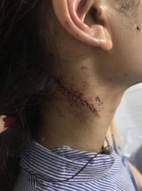 Chị gái thiếu nữ xinh đẹp bị rạch mặt: Em tôi kêu có thai mà họ vẫn không tha”-2