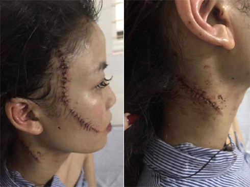 Cô gái rạch mặt khiến bạn cũ phải khâu 60 mũi trần tình: Q. đánh tôi trước, sao mọi người chỉ bênh cô ấy mà mạt sát tôi?-5