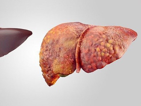 Đây là những trường hợp có nguy cơ mắc bệnh ung thư gan rất cao, số 3 nhiều người mắc phải