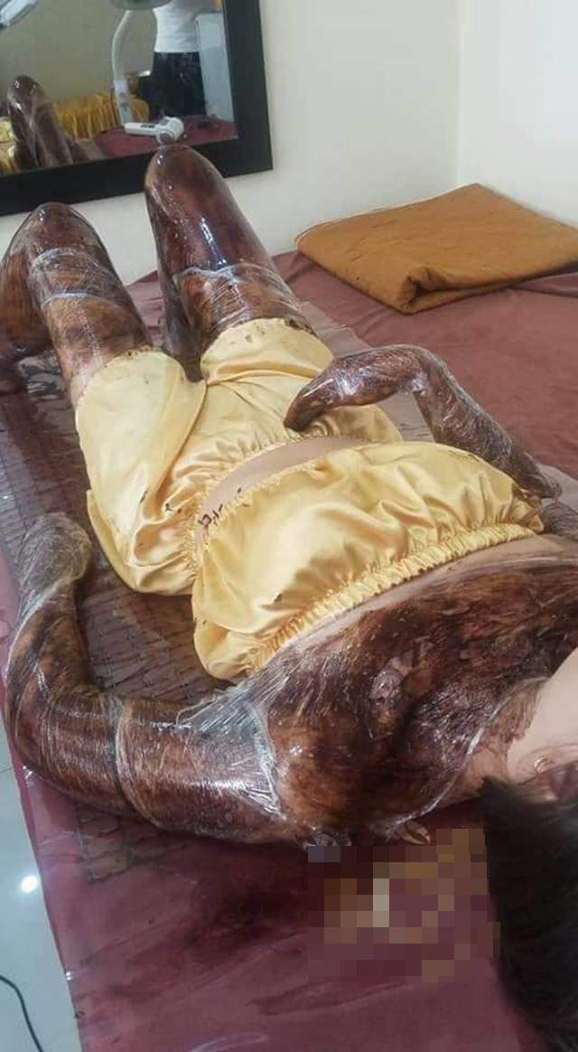 Đi tắm trắng, cô gái khiến cả mạng xã hội hốt hoảng vì da trông như... phỏng nặng-1