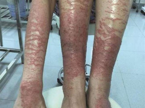 Đi tắm trắng, cô gái khiến cả mạng xã hội hốt hoảng vì da trông như... phỏng nặng