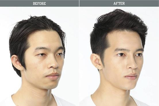 9 xu hướng phẫu thuật thẩm mỹ phổ biến nhất ở Hàn Quốc-6