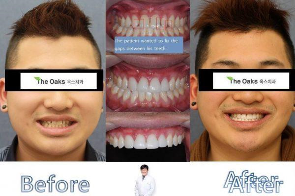 9 xu hướng phẫu thuật thẩm mỹ phổ biến nhất ở Hàn Quốc-8