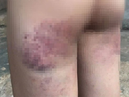 Cô giáo bị tố đánh học sinh lớp 4 bầm tím người do không làm được bài