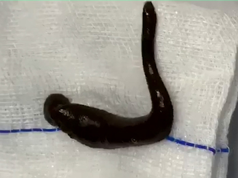 Phát hiện đỉa 3cm nằm quằn quại trong cổ họng người phụ nữ, nguyên do là vì 1 thói quen nhiều người mắc-6