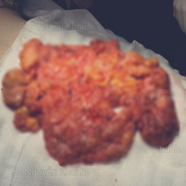 Khiếp vía với khối silicone được lấy ra khỏi ngực sau 8 năm, hội chị em còn giật mình với điều ước của bác sĩ-3