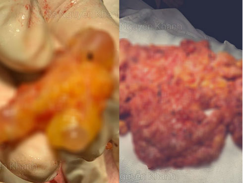 Vòng 3 biến dạng, hoại tử nghiêm trọng sau tiêm silicon-3