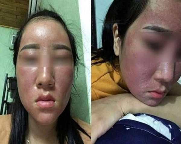 Kem trộn khiến Hồ Quỳnh Hương bị hủy hoại nhan sắc và sức khỏe: Chuyên gia nói Hậu quả còn kinh khủng hơn nữa nếu làm đẹp bằng kem trộn”-4