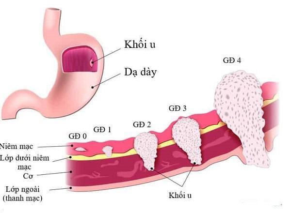 Người mẫu 8x qua đời ở tuổi 37 vì ung thư dạ dày, chuyên gia khuyến cáo gì?-2