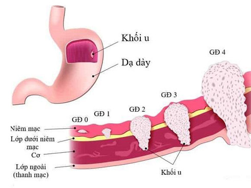 Thiếu nữ 18 tuổi đau bụng nhẹ đi khám phát hiện ung thư dạ dày giai đoạn cuối-2