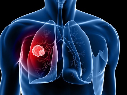 Ngoài thuốc lá thì đây chính là những nguyên nhân không ngờ gây nên bệnh ung thư phổi mà nghệ sĩ Lê Bình phải chống trọi trong thời gian dài-3