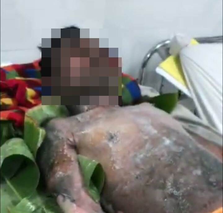 Bình gas mini phát nổ, nam thanh niên bị bỏng nặng-1