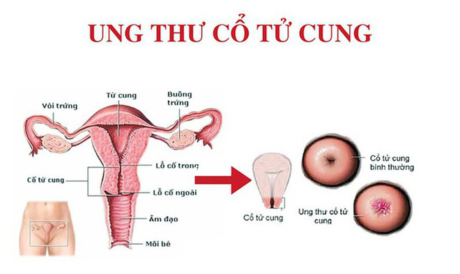 4 nhóm người có nguy cơ ung thư cao: BS khuyên khám ngay, chần chừ 1 năm cũng nguy hiểm-4