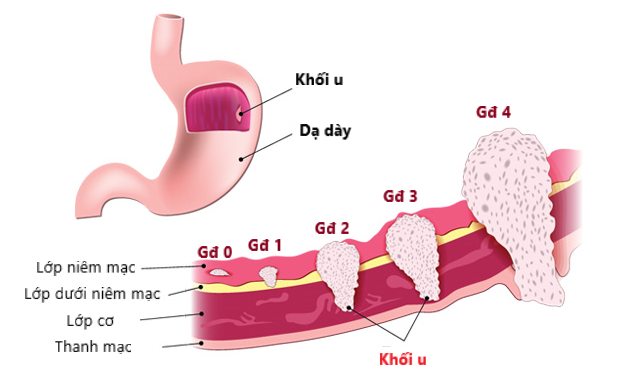 4 nhóm người có nguy cơ ung thư cao: BS khuyên khám ngay, chần chừ 1 năm cũng nguy hiểm-2