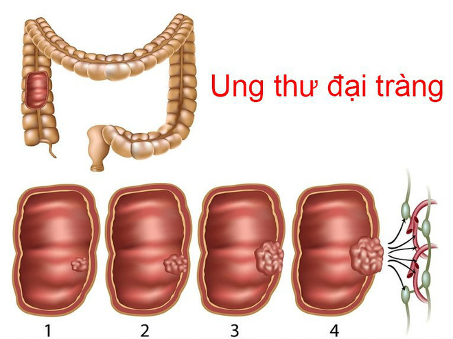 4 nhóm người có nguy cơ ung thư cao: BS khuyên khám ngay, chần chừ 1 năm cũng nguy hiểm-3