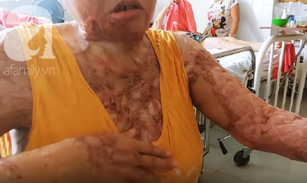 Người phụ nữ bị tình cũ tạt axit bỏng nặng sau khi níu kéo tình cảm không thành-4