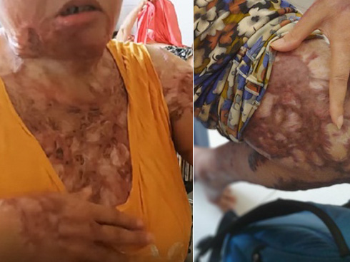 Cô giáo bị chồng tạt axit biến dạng khuôn mặt và tâm sự chua xót của người cha sau 21 lần phẫu thuật của con gái-5