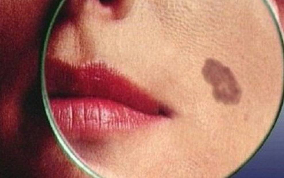 Căn bệnh ung thư từ nốt ruồi, di căn cực nhanh: Dấu hiệu khác biệt cần khám ngay-2