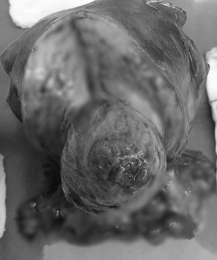 Cô dâu mang bầu 7 tuần phải cắt tử cung, chị em ghi nhớ dấu hiệu này để phòng ngừa-2