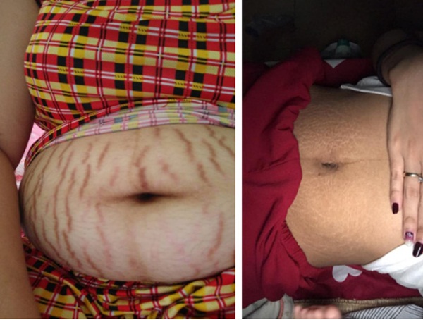 Khoe da bụng sau khi sinh nhăn như táo tàu, mẹ trẻ khiến chị em xót xa: Không gì khổ bằng nghề làm mẹ-2