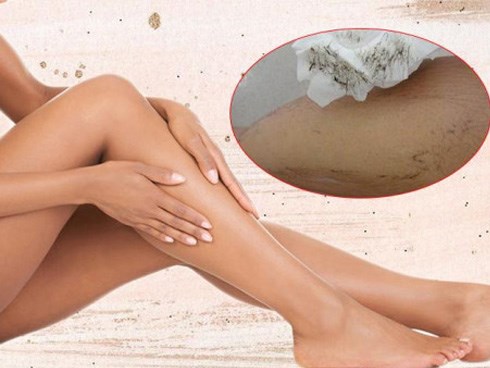 Hè rồi, đi biển chẳng dám mặc bikini vì chân nhiều lông, hãy áp dụng ngay 2 công thức này
