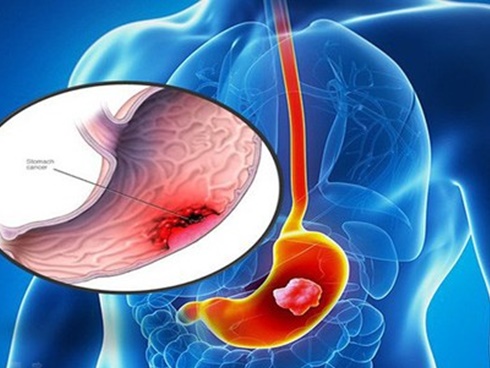 Những dấu hiệu sớm của ung thư dạ dày cần ghi nhớ-3