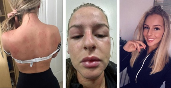 Mắc căn bệnh bí ẩn, cô gái trẻ ngày nào cũng phát ban toàn thân-3