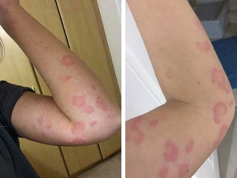Mắc căn bệnh bí ẩn, cô gái trẻ ngày nào cũng phát ban toàn thân