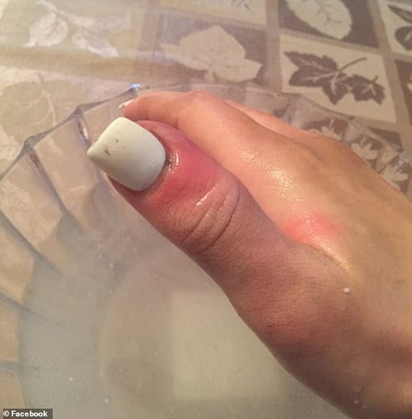 Cô gái 21 tuổi biết mình bị ung thư nhờ dấu hiệu nhỏ trên móng tay, nguyên nhân đến từ sở thích làm đẹp của rất nhiều con gái thời nay-3