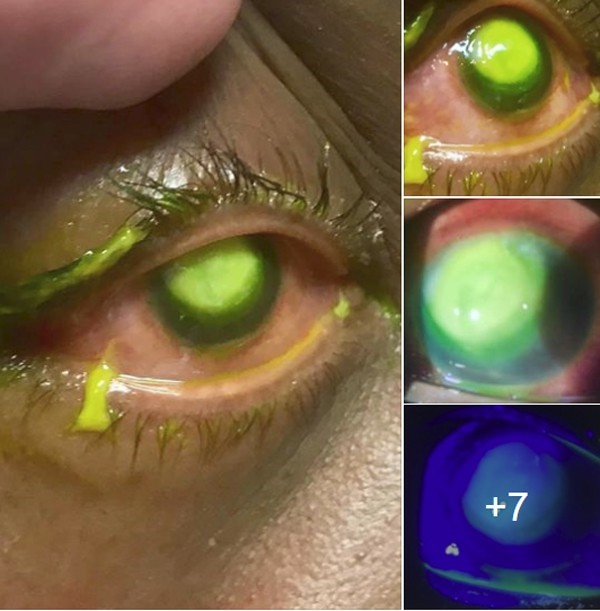 Những bức ảnh đáng sợ này chắc chắn sẽ khiến bạn nghĩ lại nếu trót lỡ đeo lens khi đi ngủ-1