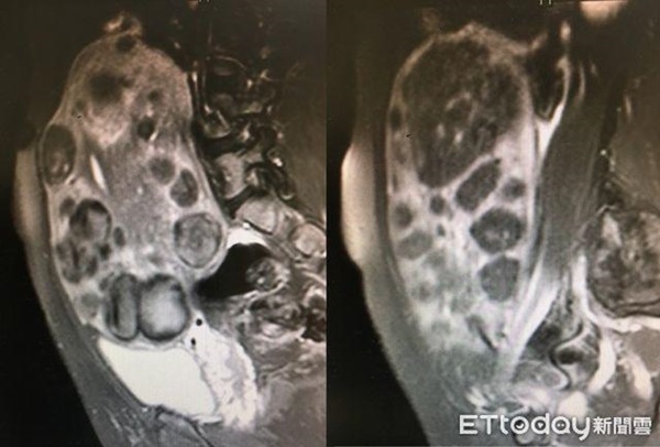 Một ngày thay tới 10 miếng BVS, nhìn phim chụp X-quang tử cung bác sĩ phải giật mình-2
