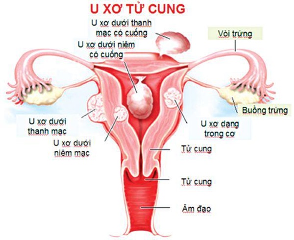 Một ngày thay tới 10 miếng BVS, nhìn phim chụp X-quang tử cung bác sĩ phải giật mình-3