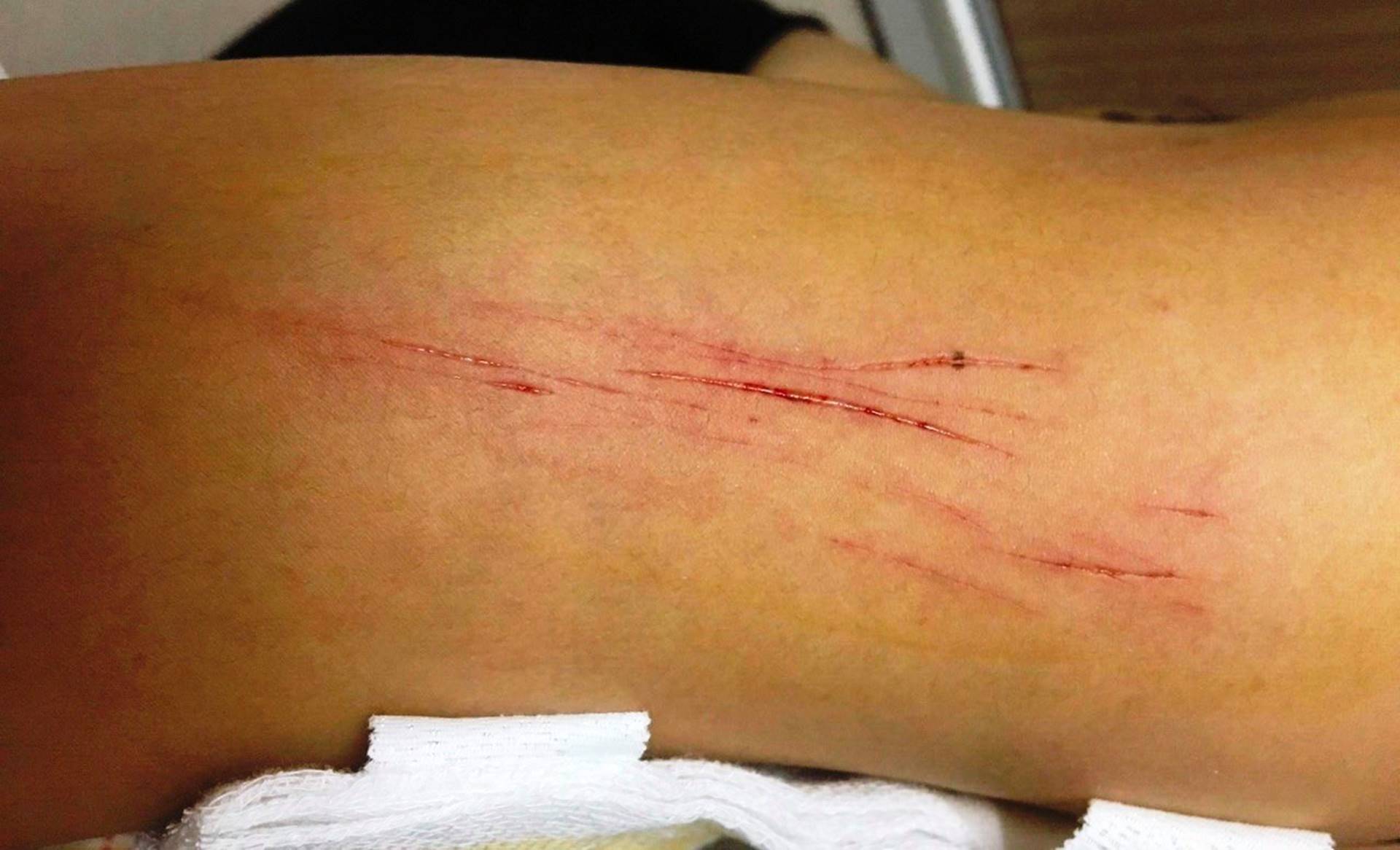 Bị 2 kẻ biến thái dùng vật nhọn đâm chảy máu khi dừng đèn đỏ, cô gái trẻ ở Sài Gòn phải điều trị chống phơi nhiễm HIV-2