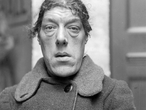 Câu chuyện cảm động về người phụ nữ mắc bệnh lạ