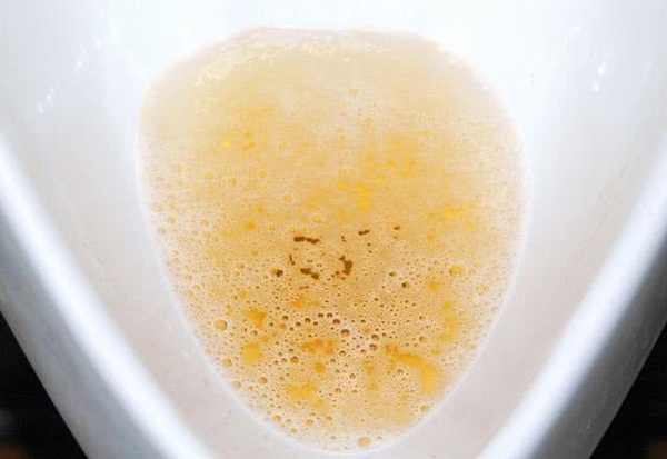 Thấy có 4 dấu hiệu bất thường này ngay khi thức dậy, cẩn thận ung thư gan đang đến rất gần-1