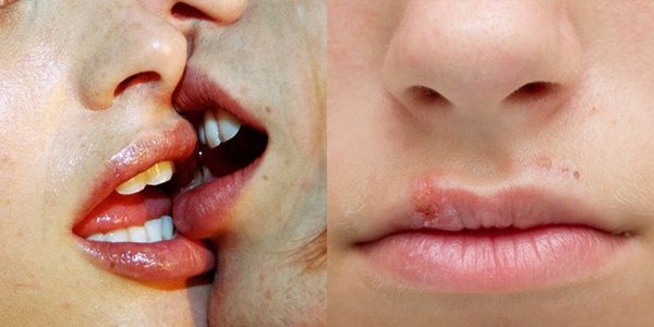 Cảnh báo: Hôn nhau kiểu này dù rất lãng mạn nhưng có thể khiến bạn lây bệnh lậu ở cổ họng-2