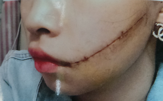 Người phụ nữ có gia đình bị người tình rạch mặt lúc đang âu yếm nhau vì cùng lúc quen nhiều người-1