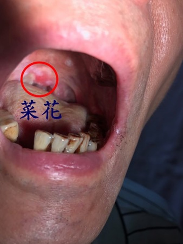 Chỉ vì thói quen này khi quan hệ tình dục mà một người đàn ông phải đi tiêm vắc-xin ngừa ung thư cổ tử cung-1