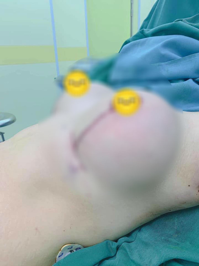 Mẹ trẻ gây ám ảnh với bộ ngực chảy xệ, da bụng rạn nứt tung tóe sau sinh-2