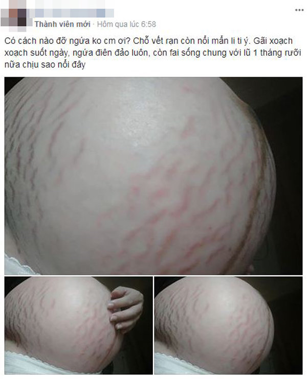 Mẹ trẻ gây ám ảnh với bộ ngực chảy xệ, da bụng rạn nứt tung tóe sau sinh-3