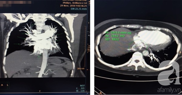 Sản phụ sinh con 4 tháng đã mắc bệnh hiểm, nguy cơ tử vong tới 90%: Cảnh báo căn bệnh đe dọa tính mạng phụ nữ mang thai-5