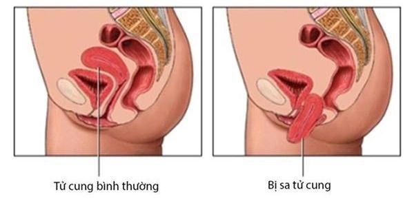 Người phụ nữ sợ hãi khi thấy miếng thịt rơi khỏi vùng kín, chẩn đoán của BS còn sốc hơn-2