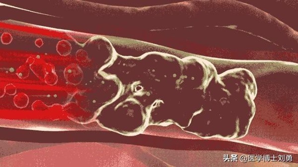 3 dấu hiệu bất thường ở tay chân: 80% khả năng bạn bị tắc mạch máu, nên xử lý ngay-2