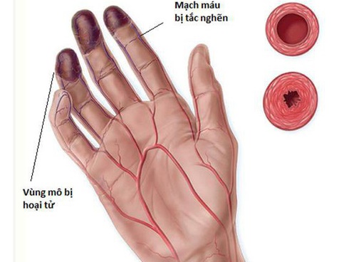 5 dấu hiệu cảnh báo chứng tắc mạch máu, đề phòng tử thần gõ cửa, nguy hiểm nhất là số 1-2