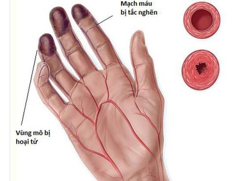 3 dấu hiệu bất thường ở tay chân: 80% khả năng bạn bị tắc mạch máu, nên xử lý ngay