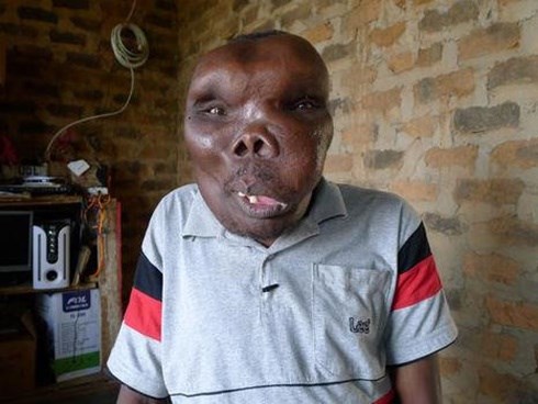 Hành trình trở thành ngôi sao của người đàn ông mắc bệnh ‘mặt rắn’